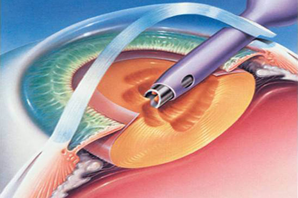 Best Eye Hospital in Chhattisgarh